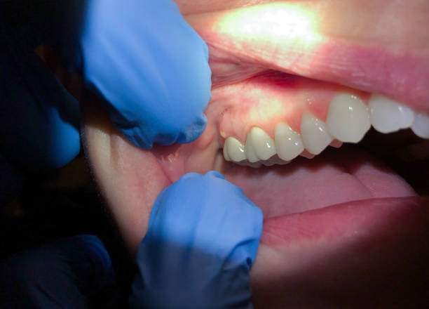 Best Emergency Dental Care for Sports Injuries in Shil, OH